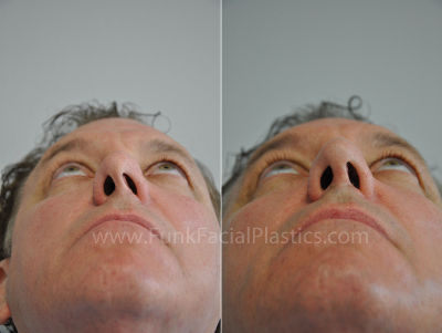 Revision Rhinoplasty for Man