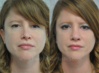 Rhinoplasty Houston