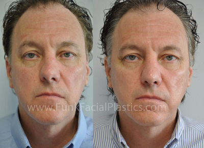 Male Revision Rhinoplasty