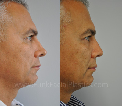 Rhinoplasty Houston