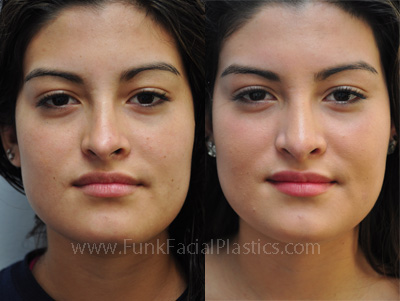 Revision Rhinoplasty Specialist in Houston