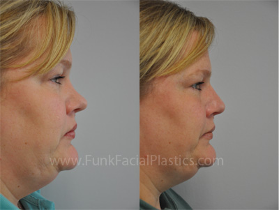 Houston Rhinoplasty