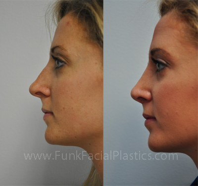 Revision nose surgery in Houston