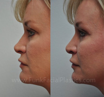 Nose surgery in Houston, Texas