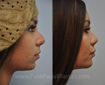 Silicone chin augmentation Houston