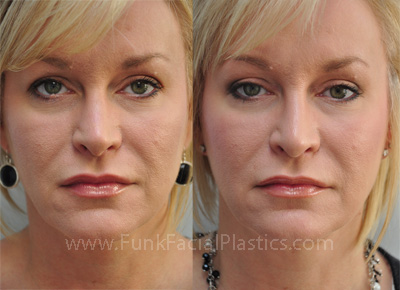 Top Nose Surgeon Houston