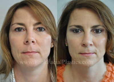 Revision Rhinoplasty Houston for Woman