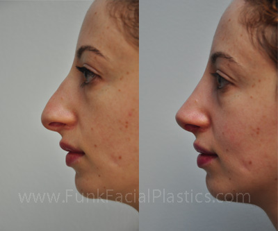 Revision nose job Houston