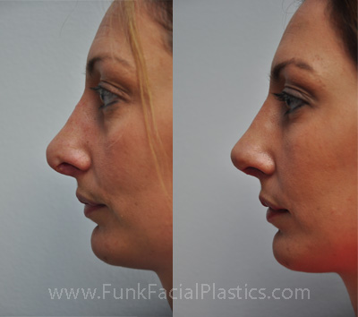 Revision nose job Houston