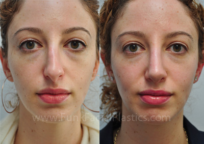 Revision nose surgery Houston