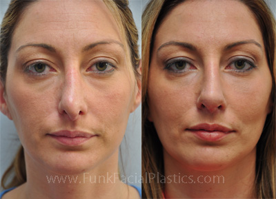 Revision nose surgery Houston