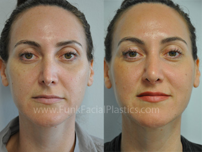 Revision Rhinoplasty Houston