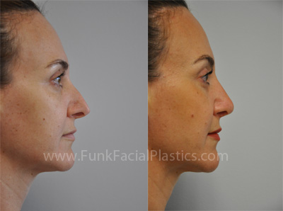 Revision Nose Job Houston