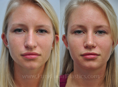 Nose Surgery Houston