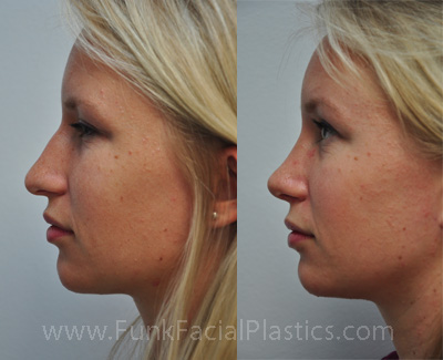 Top nose surgeon houston