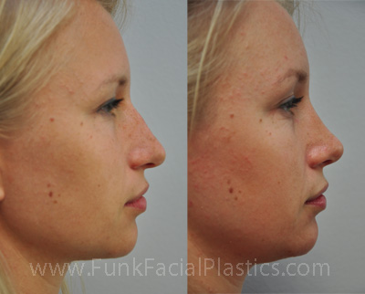 Rhinoplasty Houston