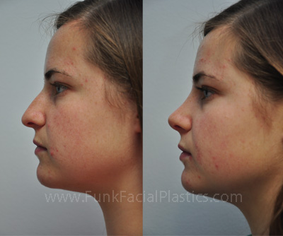 Rhinoplasty Expert Houston