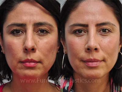 Top Nose Surgeon Houston