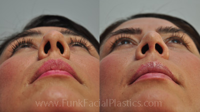 Scar from Rhinoplasty