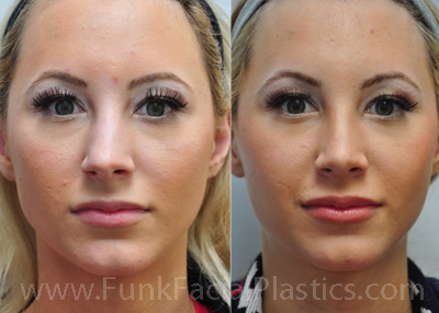 Best Rhinoplasty surgeon in Houston