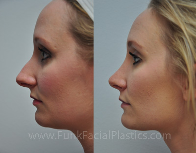 Top Nose Surgeon in Texas