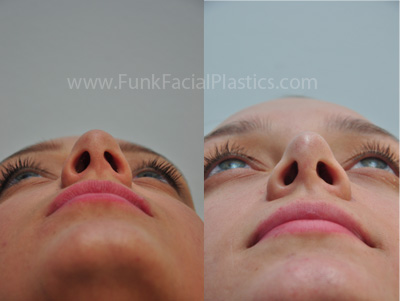 Best rhinoplasty surgeon in Houston