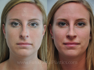 Rhinoplasty Houston