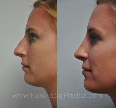 Nose Job Houston