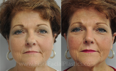 Nose surgery Houston