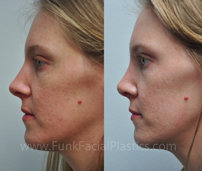 Nose Surgery Houston