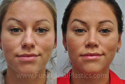 Best Rhinoplasty Surgeon in Texas