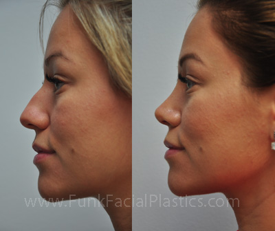 Top nose surgeon Houston