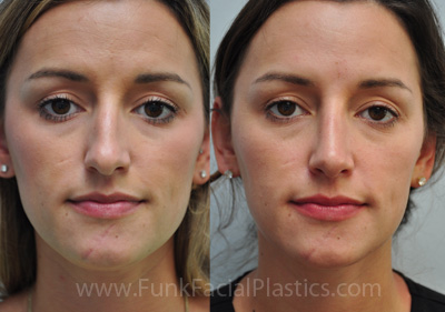 Best rhinoplasty surgeon Houston