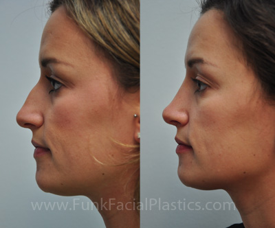 Nose Job Houston