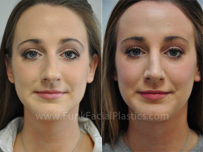 Nose job Houston