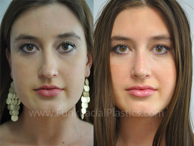 Rhinoplasty for bulbous tip