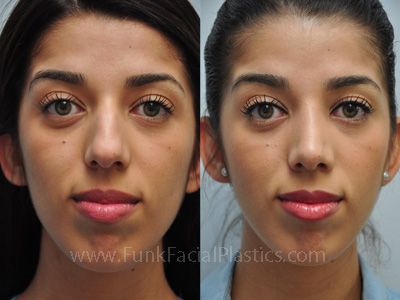 Nose Job Houston