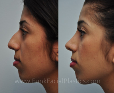 Nose Surgery Houston