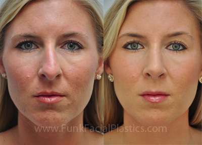 Rhinoplasty Specialist Houston