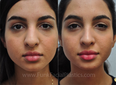 Rhinoplasty Houston