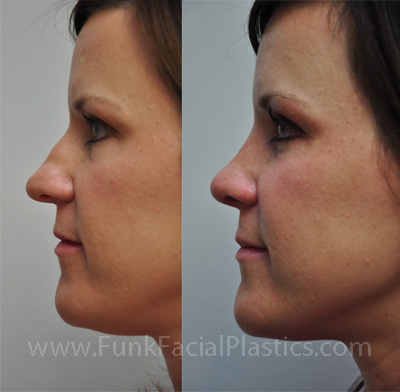 Rhinoplasty Before and after Houston