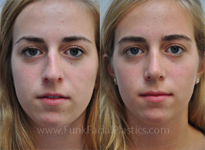 Is Rhinoplasty Worth It?