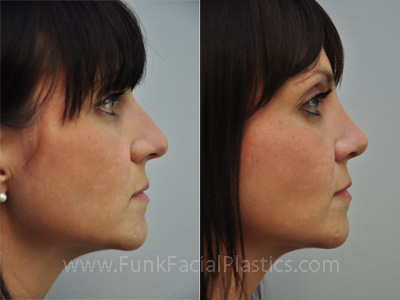 Nose Surgery Houston