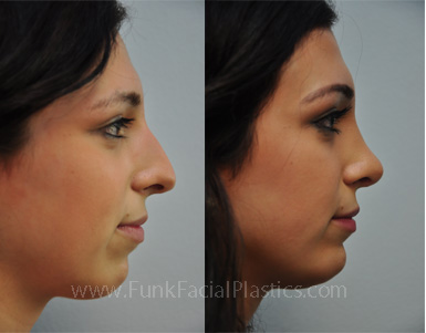 Nose surgery Houston