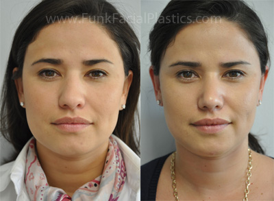 Nose surgery Houston