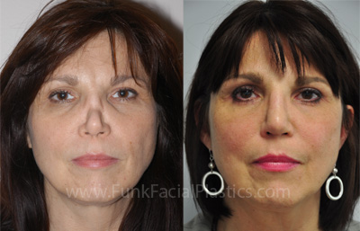 Rhinoplasty with Rib cartilage