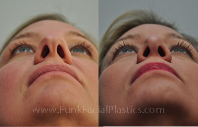 Bublous tip nose surgery Houston