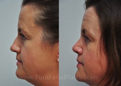 Nose job for crooked nose in Houston