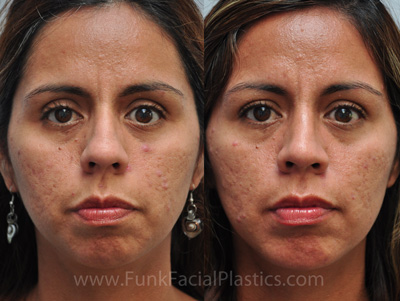 Hispanic Nose Surgery Houston