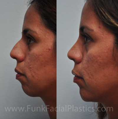 Chin Implant Houston